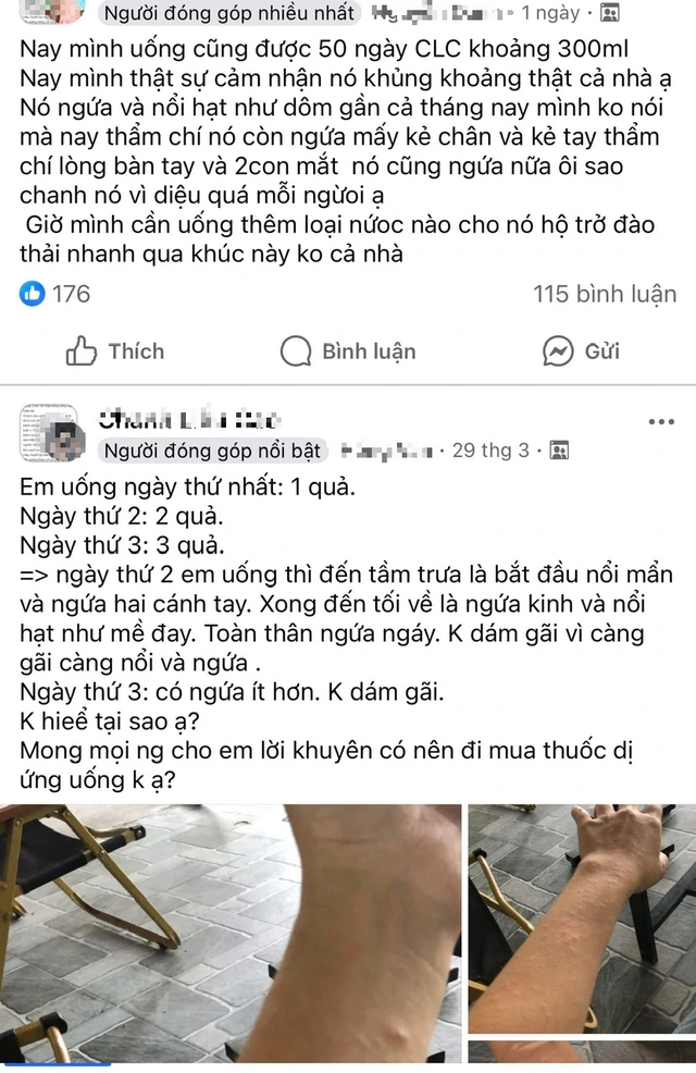 Cẩn trọng trào lưu trên mạng xã hội: Ngứa sau thời gian uống nước chanh, do đâu? - Ảnh 1.