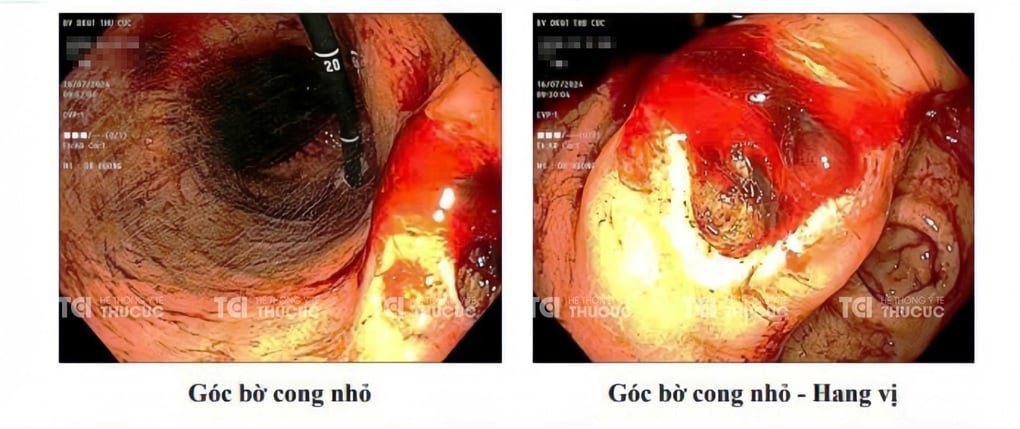 Loét dạ dày do HP kháng thuốc: Điều trị hiệu quả với phác đồ 4 thuốc - 1