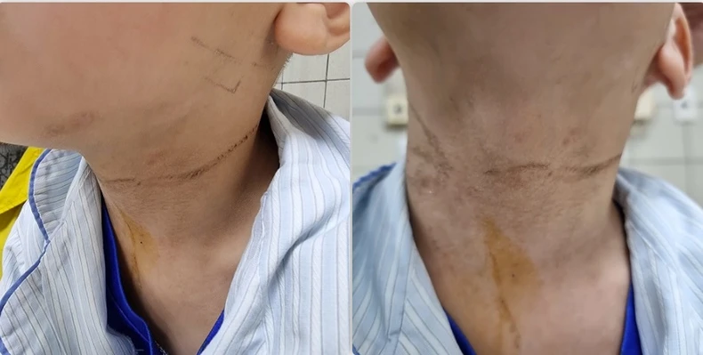 Bé trai 5 tuổi tím tái vì bị dải rút quần "thắt cổ" ảnh 1