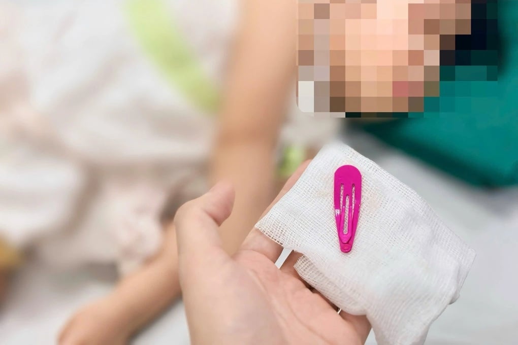 Hà Nội: Bé gái 21 tháng tuổi nuốt kẹp tóc vào bụng - 1
