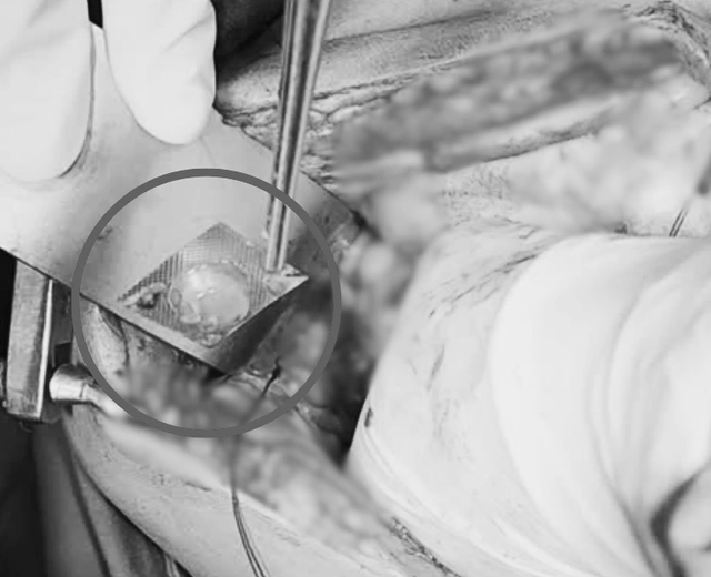 激しい腹痛で入院、鋭い鉄の殻の錠剤による腸穿孔が発見される - 写真1。