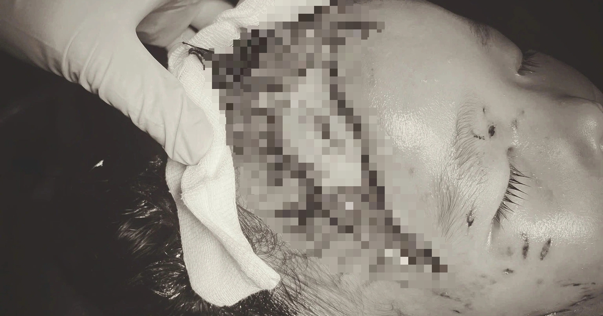 Niño de 2 años mordido por perro deja el cráneo expuesto mientras visitaba a un familiar