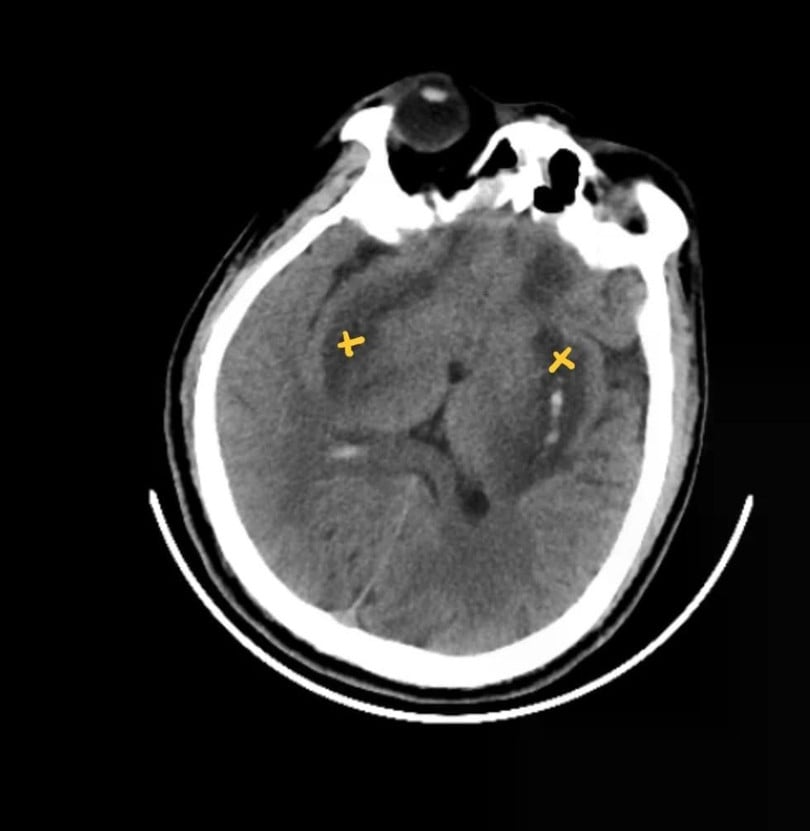 Hình ảnh chụp MRI não bệnh nhân: nhân bèo hai bên não bị hoại tử và chảy máu. Ảnh: BVCC.