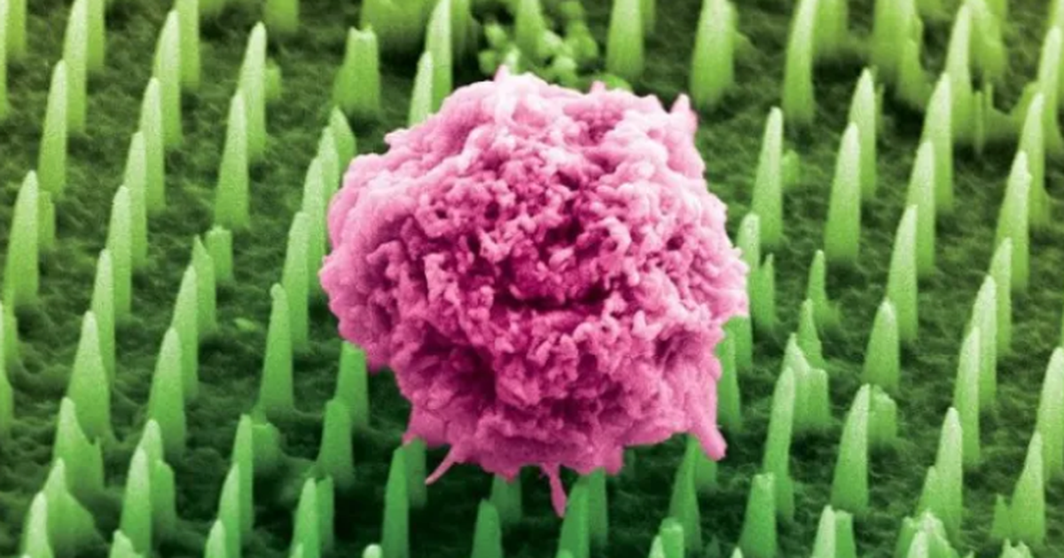 Breakthrough in cancer diagnosis: Micro patches replace biopsies