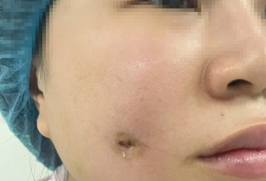 Người phụ nữ bị nhiễm trùng sau khi làm má lúm đồng tiền tại spa - 1