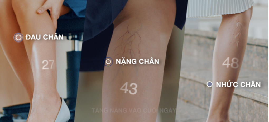 Giải pháp cải thiện triệu chứng suy giãn tĩnh mạch từ Pháp - 1