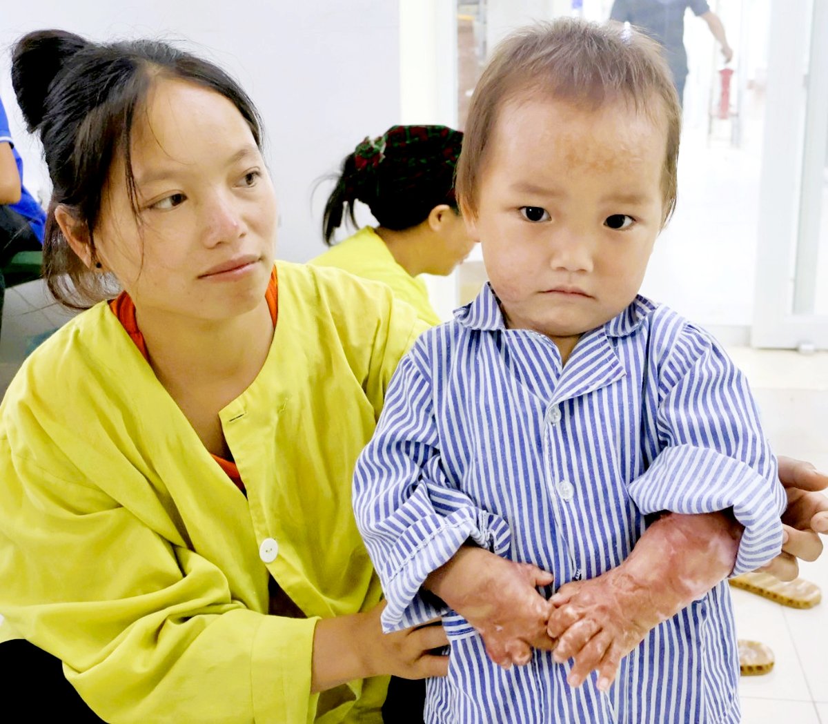 Nỗi buồn hiện lên trên khuôn mặt của người mẹ do những vết sẹo bỏng hằn trên da thịt đứa con.