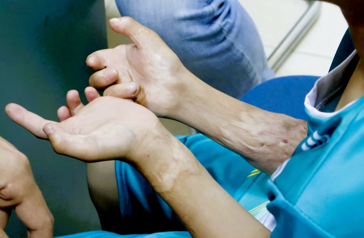 Sẹo bỏng trên cả hai bàn tay khiến em nhỏ này gặp khó khăn trong cuộc sống, sinh hoạt hàng ngày.