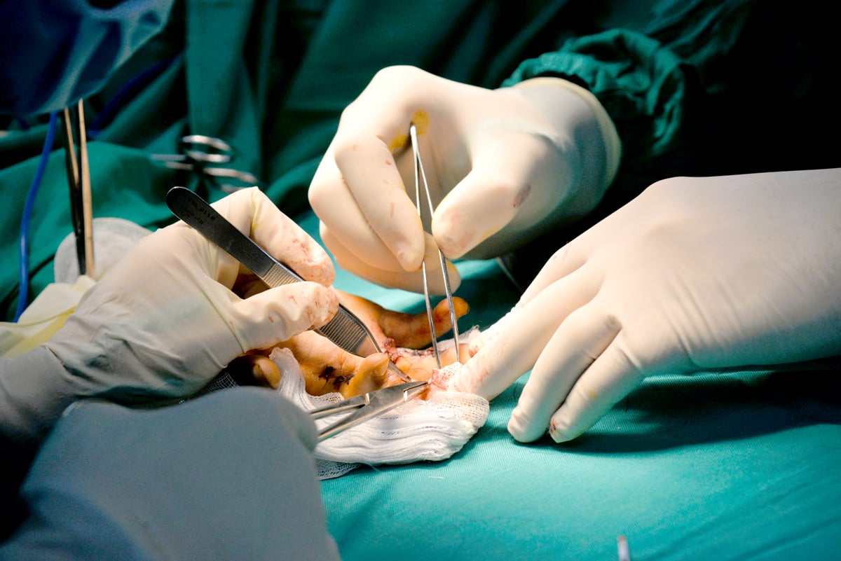 Việc phẫu thuật tạo hình các ngón tay dính như chân vịt luôn đòi hỏi sự khắt khe, kiên nhẫn.