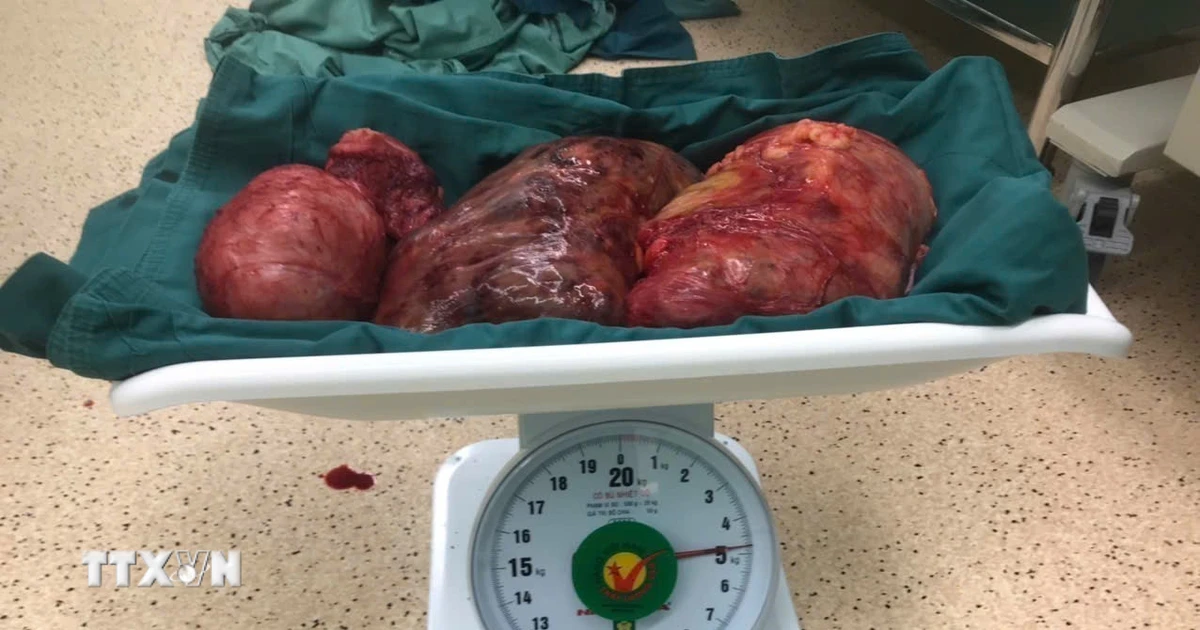 Phẫu thuật cắt khối u xơ nặng gần 5kg trong người bệnh nhân 56 tuổi