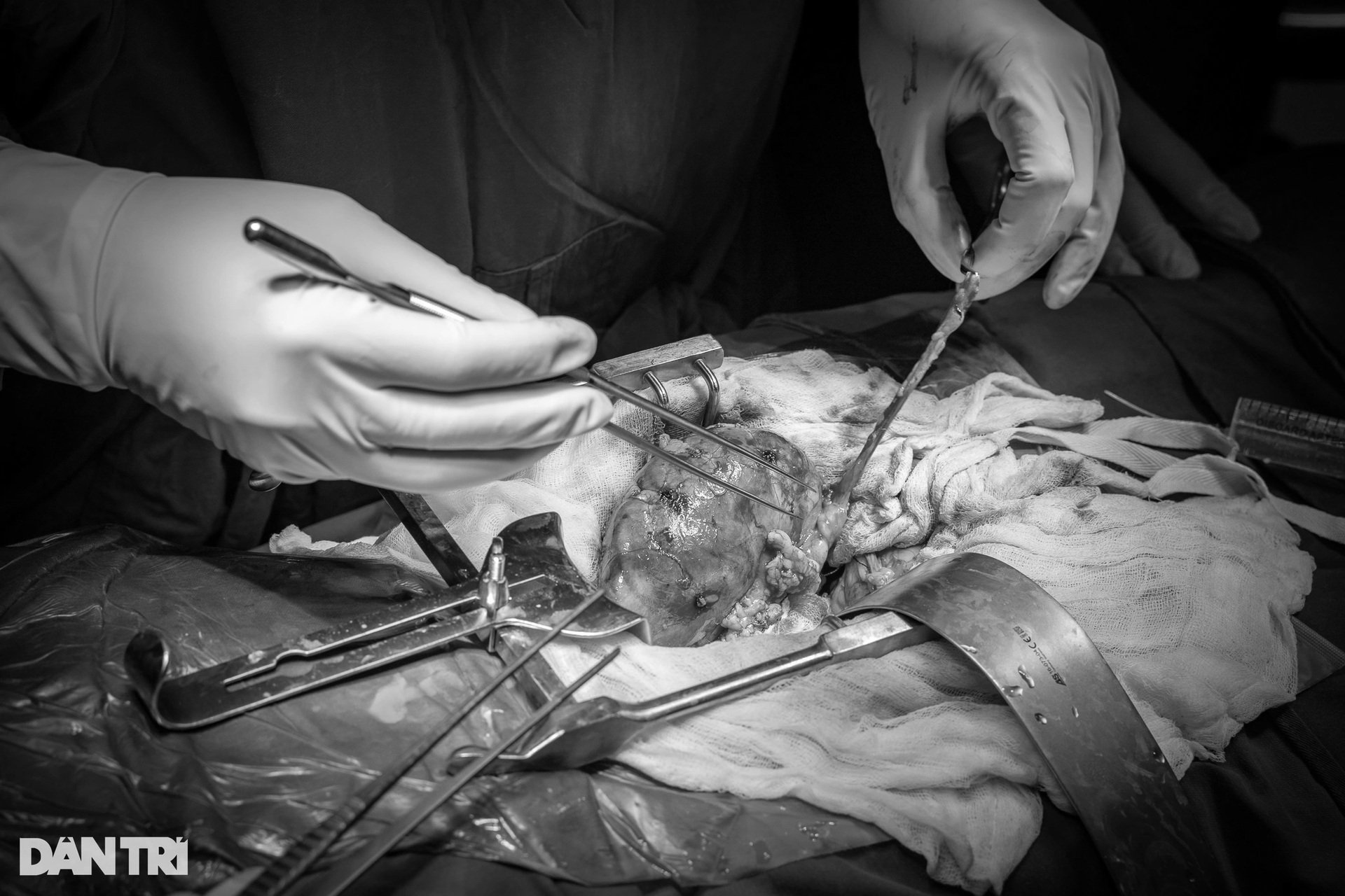 Cận cảnh 30 y bác sĩ giải cứu cô gái suy thận 10 năm không thể uống nước - 18