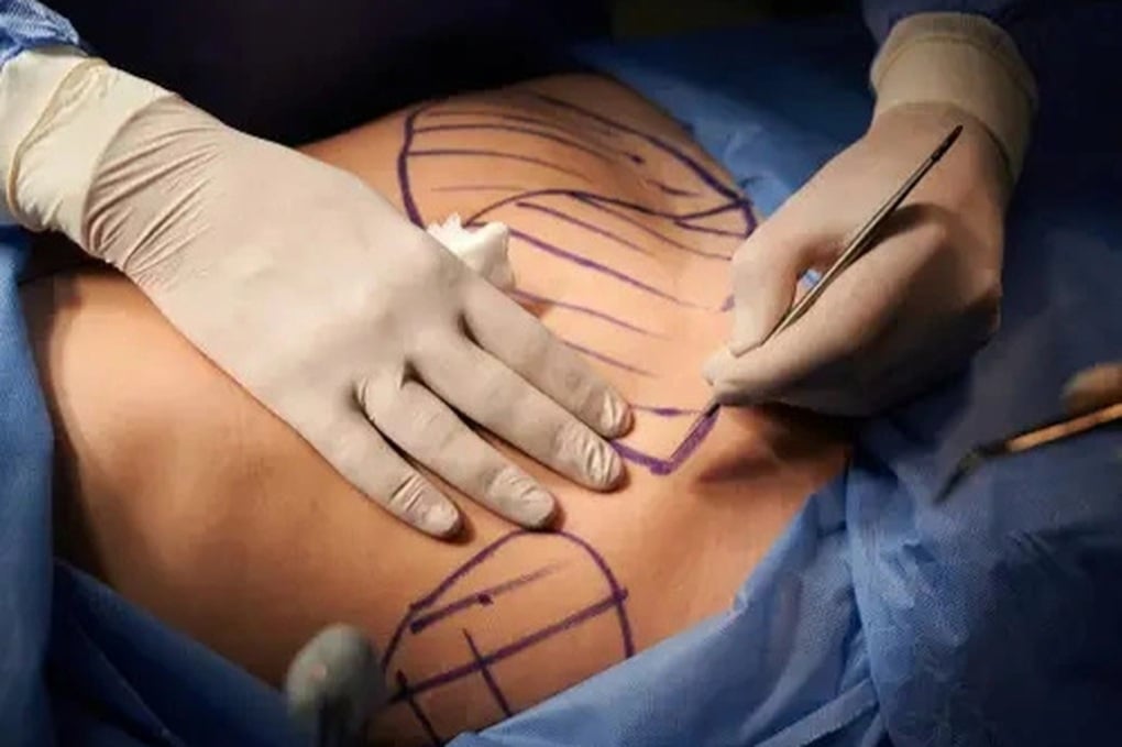 Nam giới chi hàng chục nghìn USD dao kéo để có cơ bụng 6 múi - 1