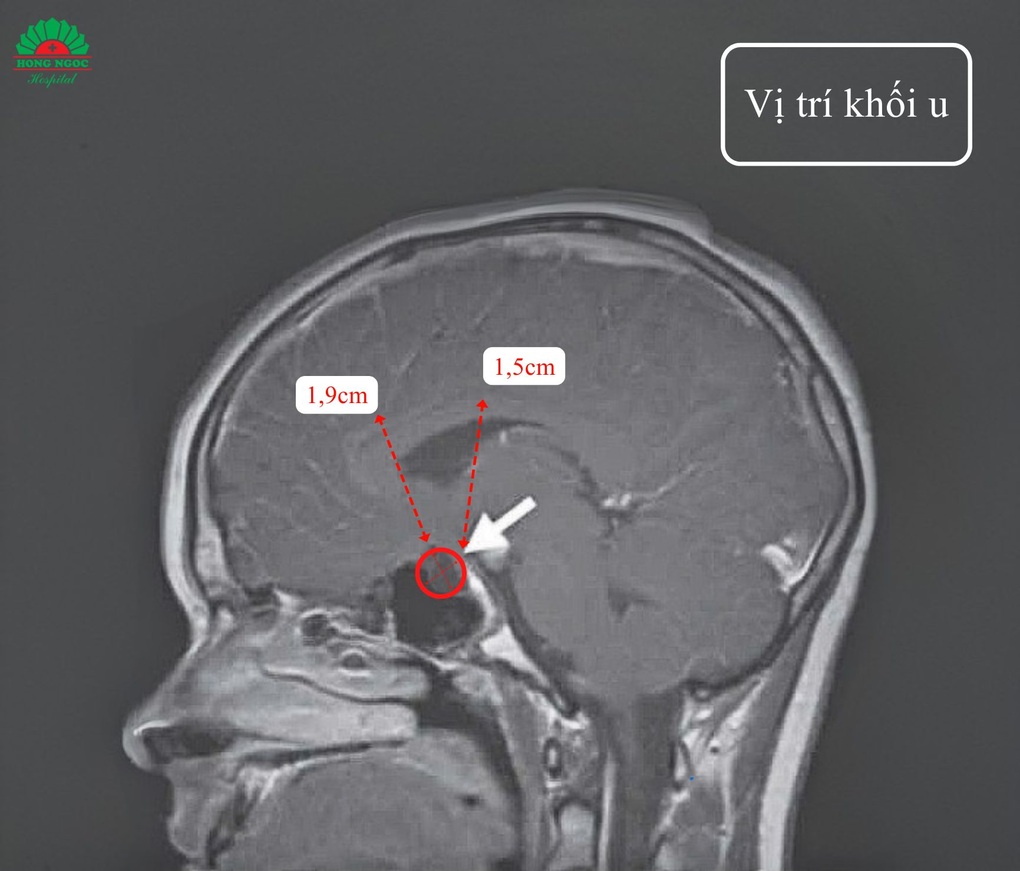 Bé gái 6 tuổi bất ngờ phát hiện khối u vùng não khi tầm soát dậy thì sớm - 2