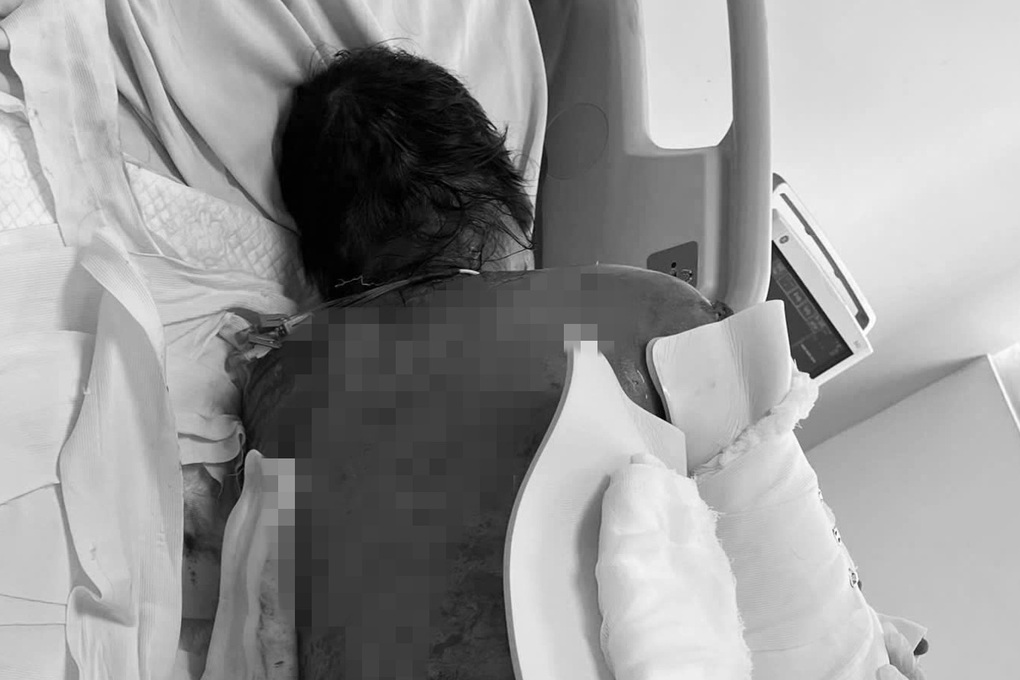 抗生物質を服用した女性の皮膚が92％剥がれる珍しい症候群 - 1