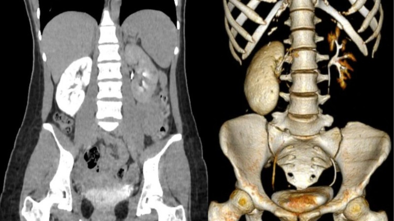 The 18-year-old patient's kidneys were almost 