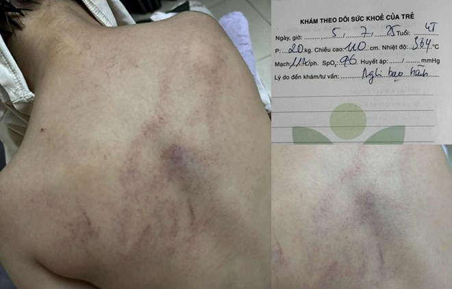 Mạng xã hội phẫn nộ trước sự việc bé gái 4 tuổi bị giáo viên đánh tím lưng. (Ảnh: Gia đình cung cấp)