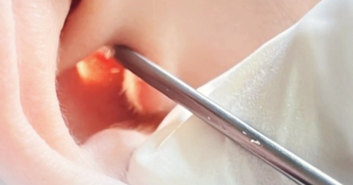 TPHCM: Cấp cứu người mẹ thủng màng nhĩ vì con trai chơi bóng trong nhà