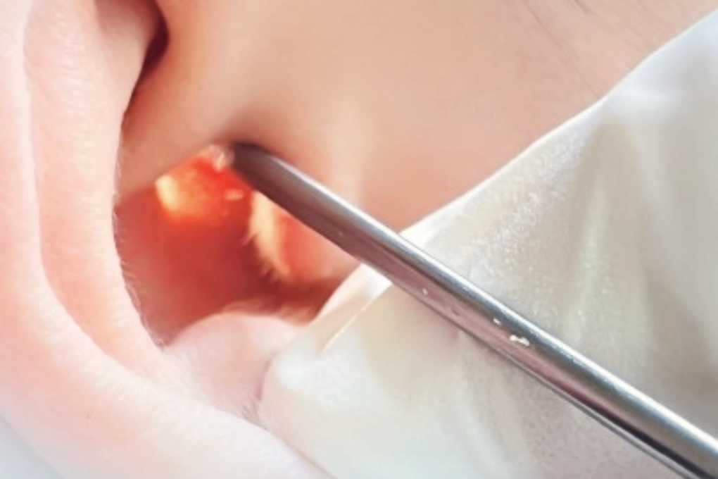 TPHCM: Cấp cứu người mẹ thủng màng nhĩ vì con trai chơi bóng trong nhà - 2