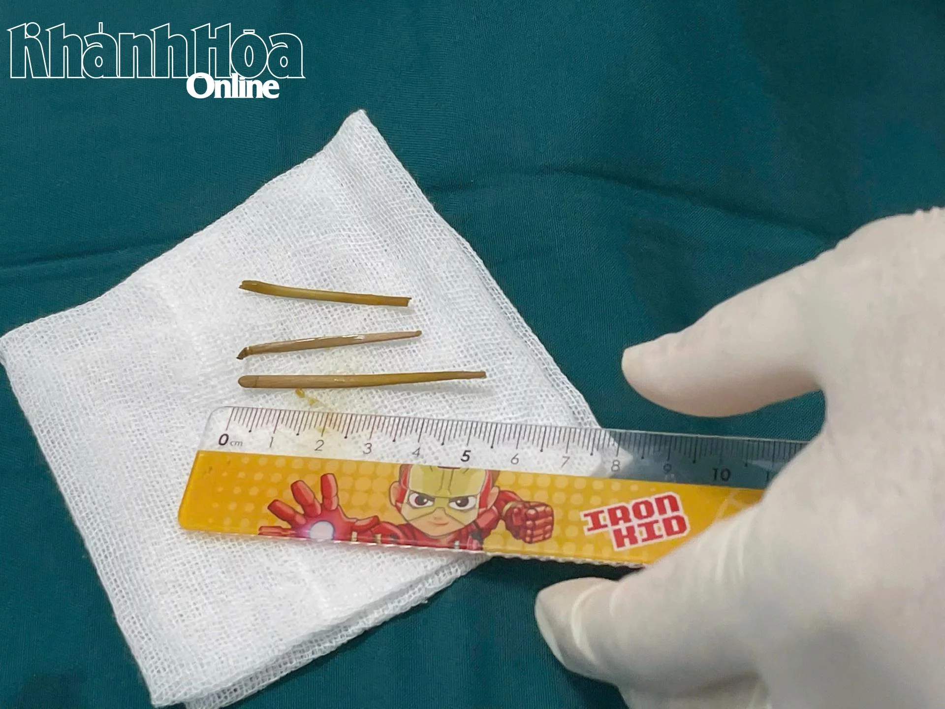 Các  mảnh  xương  gắp  ra  từ  đại tràng  của  bệnh  nhân