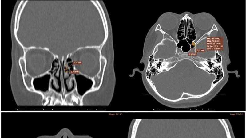 Hình ảnh chụp CT-Scanner xoang phát hiện tình trạng viêm đa xoang hàm mặt.