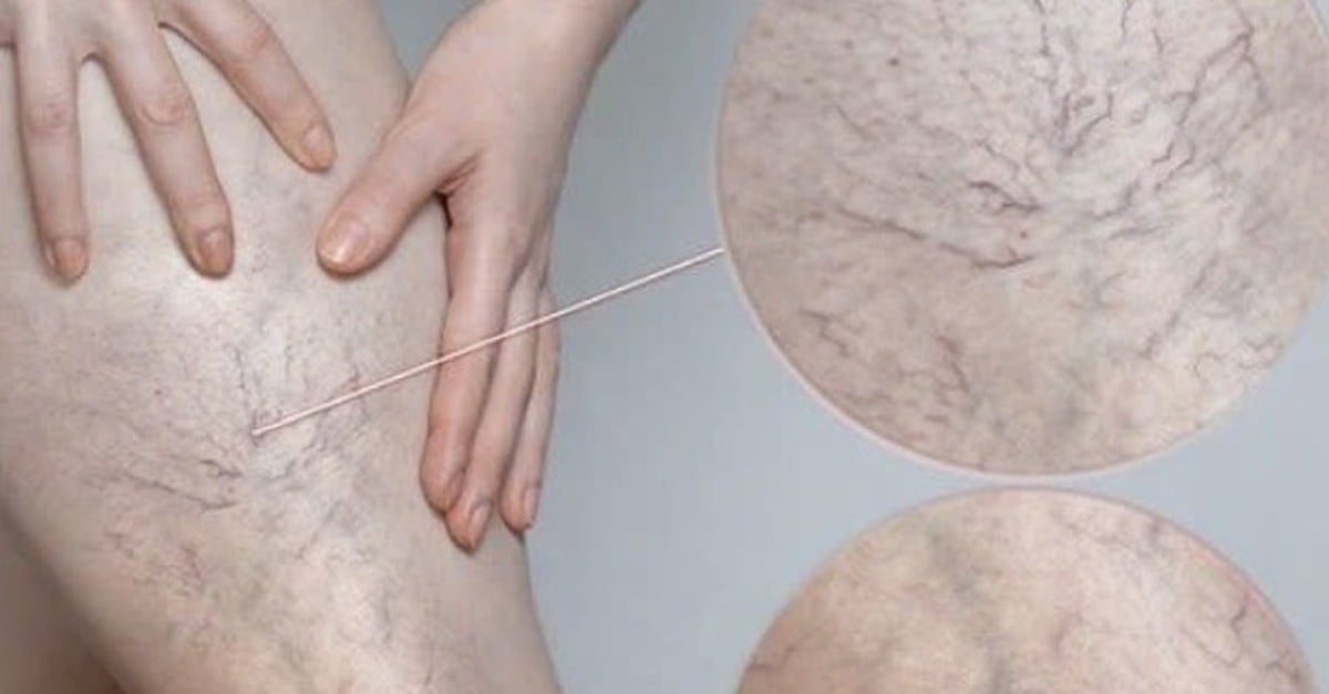 Chân đau nhức, mạch máu lộ rõ cảnh báo bệnh lý đang đe dọa 1/3 người trưởng thành