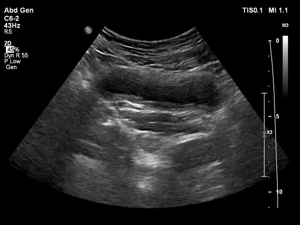 Hà Nội: Người phụ nữ tiểu ra máu vì hai thói quen nguy hiểm - 2