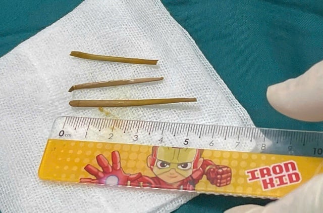 Đau bụng 1 năm mới phát hiện 3 xương cắm sâu trong đại tràng- Ảnh 3.