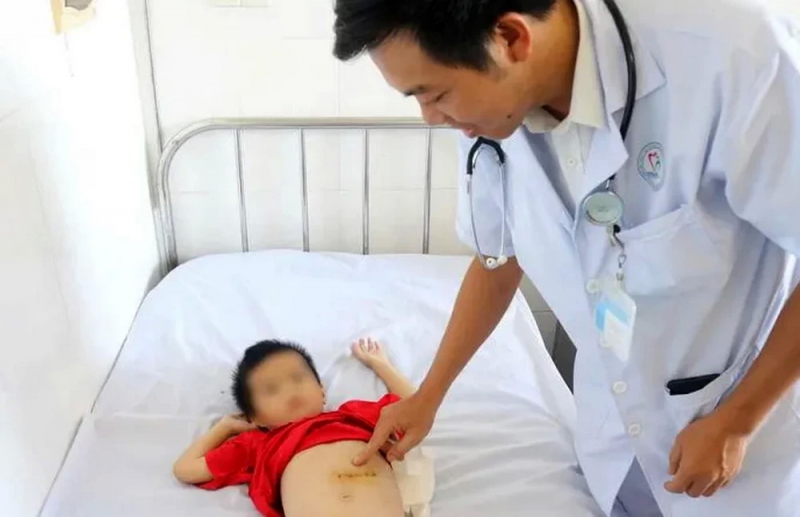 Phẫu thuật lấy búi tóc khoảng nửa ký trong dạ dày nam bệnh nhi 5 tuổi -0