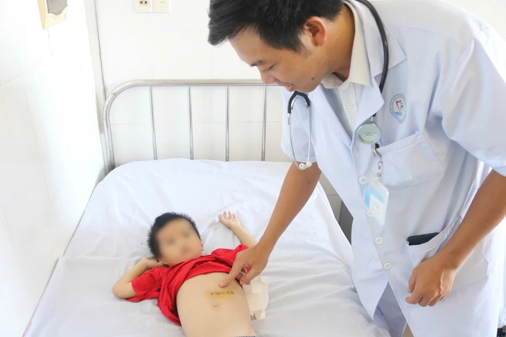 Phẫu thuật lấy búi tóc nặng nửa ký khỏi dạ dày bệnh nhi 5 tuổi - Ảnh 1.