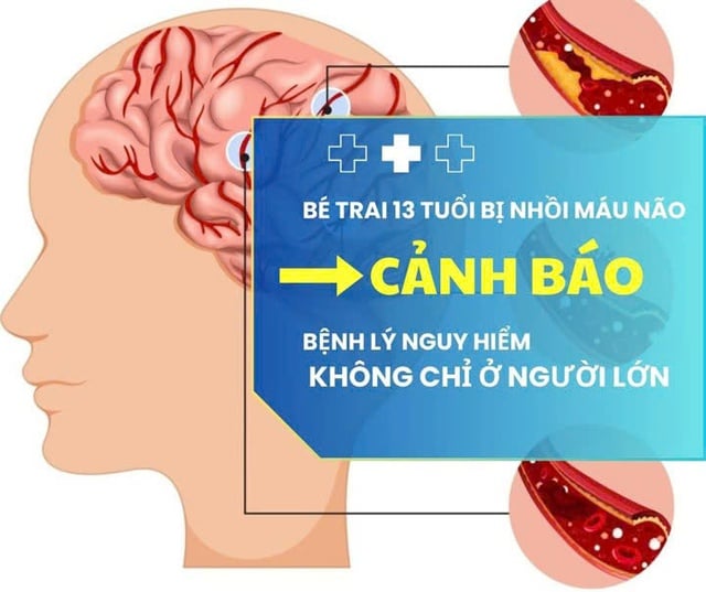 Bé trai 13 tuổi bị nhồi máu não cảnh báo nguy cơ đột qụy ở thiếu niên - Ảnh 1.