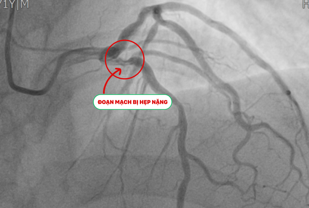 Phát hiện tổn thương tim trước ca mổ cột sống, cụ ông được xử trí kịp thời - 1