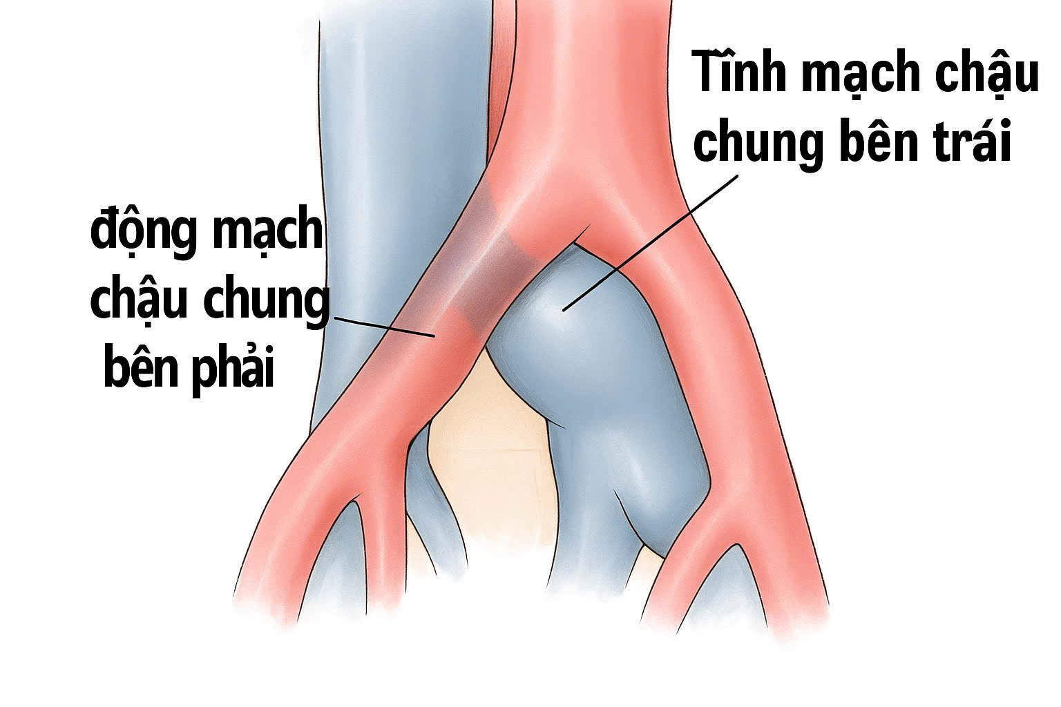 ស្ថានភាព​នៃ​សរសៃឈាម​អាកទែរ​ដែល​សង្កត់​សរសៃ​វ៉ែន​បណ្តាល​ឱ្យ​ស្ទះ​សរសៃឈាម (រូបថត​អ៊ីនធឺណិត)