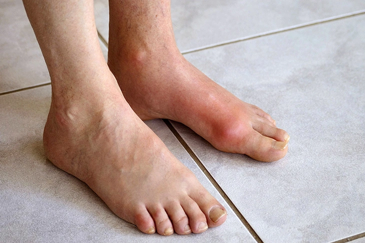 Chàng trai trẻ mắc bệnh gout ở tuổi 22, dấu hiệu cảnh báo từ đau khớp cổ chân - Ảnh 1.