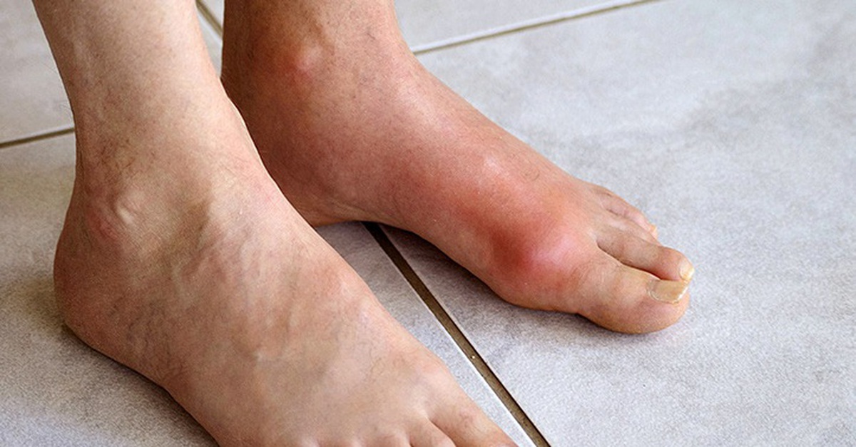 Chàng trai trẻ mắc bệnh gout ở tuổi 22, dấu hiệu cảnh báo từ đau khớp cổ chân