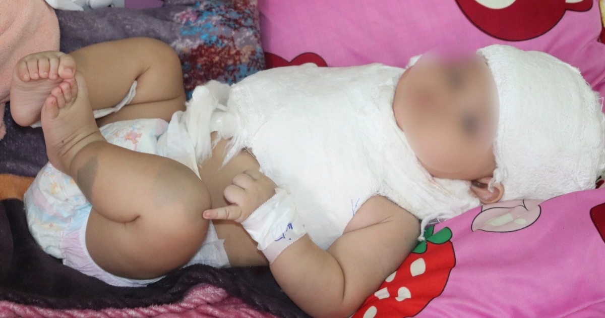 „Gefährliche“ Krankheit, die durch ein Geburtstrauma verursacht wird und bei der das Baby direkt nach der Geburt gelähmte Arme hat