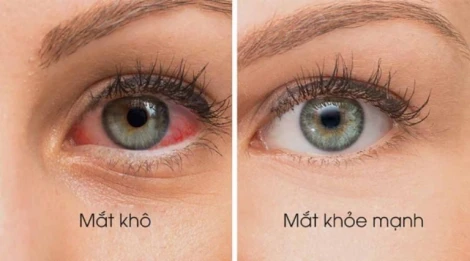 Bị khô mắt nên nhỏ thuốc gì? Gợi ý thuốc nhỏ mắt phù hợp và hiệu quả