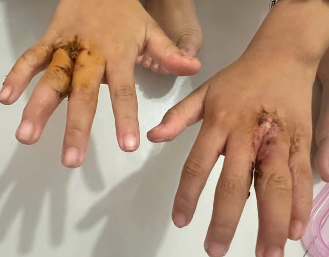 TP.HCM: Phẫu thuật tách bàn tay dính ngón cho bé trai 6 tuổi - Ảnh 2.