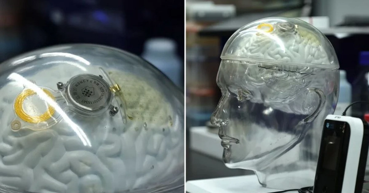 Neuralink ដំបូងបានបញ្ចូលបន្ទះសៀគ្វីចូលទៅក្នុងអ្នកជំងឺ 2 នាក់ក្នុងមួយថ្ងៃ