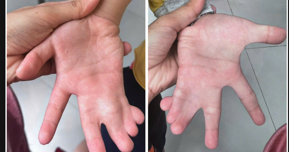 TP.HCM: Phẫu thuật tách bàn tay dính ngón cho bé trai 6 tuổi
