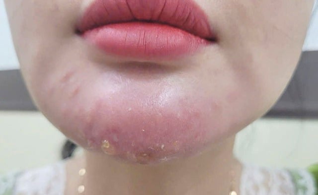 Tiêm filler không rõ nguồn gốc, một phụ nữ bị biến chứng nguy hiểm- Ảnh 1.