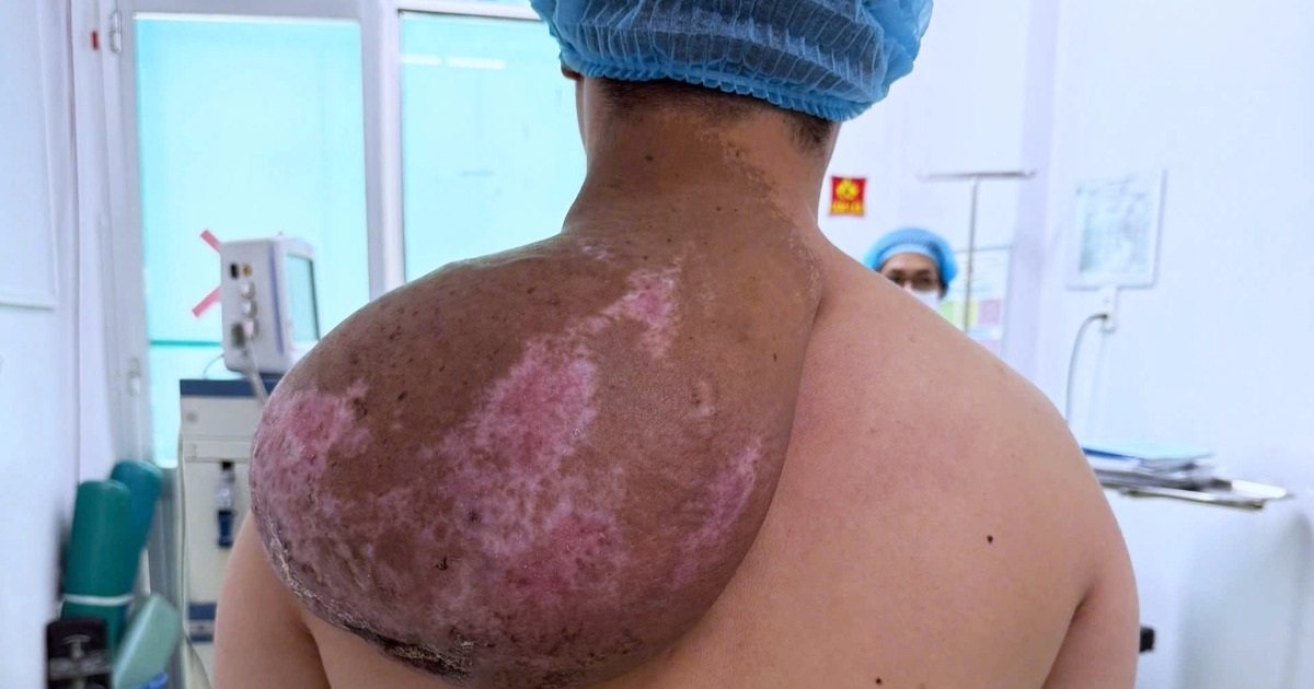 Мальчик с деформированным телом, 5 лет несущий «камень» на плече из-за редкой болезни