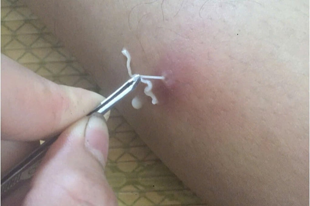 Những món ăn quen thuộc trên mâm cơm người Việt là ổ ký sinh trùng - 1