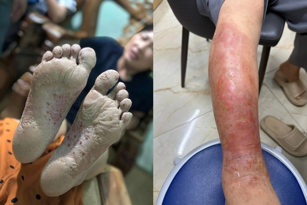 Cẩn trọng với bệnh vùng lũ: Một vết ngứa nhỏ có thể thành ổ nhiễm trùng - 1