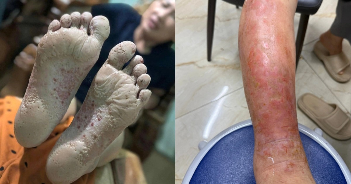 Cẩn trọng với bệnh vùng lũ: Một vết ngứa nhỏ có thể thành ổ nhiễm trùng