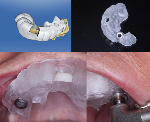 Ứng dụng 'GPS nha khoa' X-Guide: Bước tiến mới trong cấy ghép Implant- Ảnh 1.