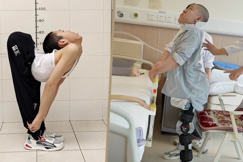 Bước ngoặt của nam sinh bị biến dạng cột sống nặng nề - 1