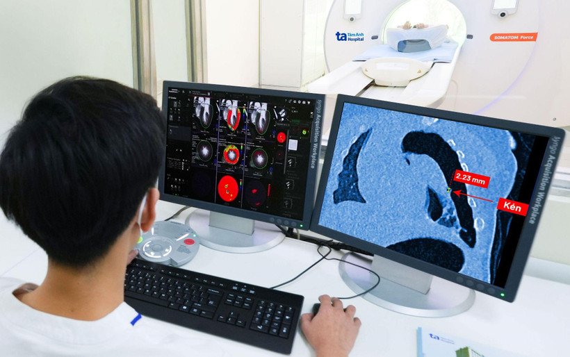 La imagen tomada con el tomógrafo Somatom Force VB30 muestra un quiste pulmonar roto con un diámetro extremadamente pequeño, solamente unos 2 mm, del paciente infantil.