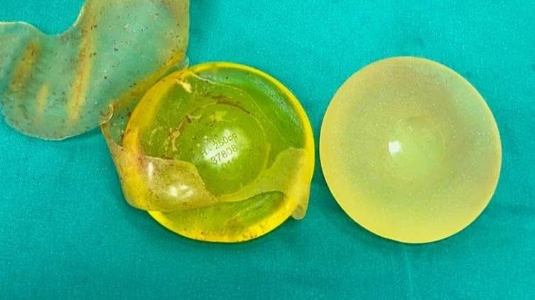 Túi ngực sau phẫu thuật tháo bỏ. 