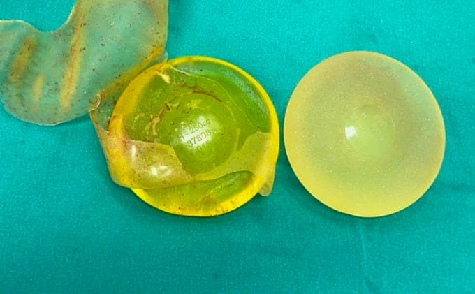 Túi ngực sau phẫu thuật tháo bỏ. Ảnh: Bệnh viện Đa khoa Tâm Anh