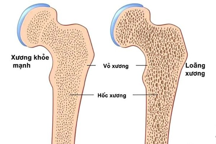 Làm gì để phòng ngừa bệnh loãng xương? - Ảnh 1.